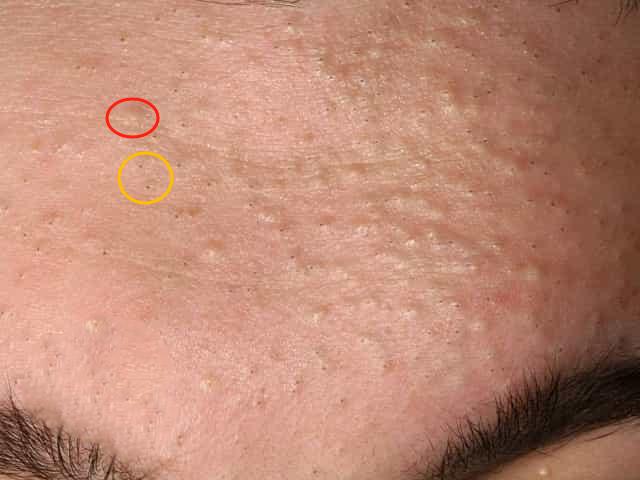 闭口粉刺、痘痘（痤疮）、毛囊炎……身上长的这些痘痘该怎么清除