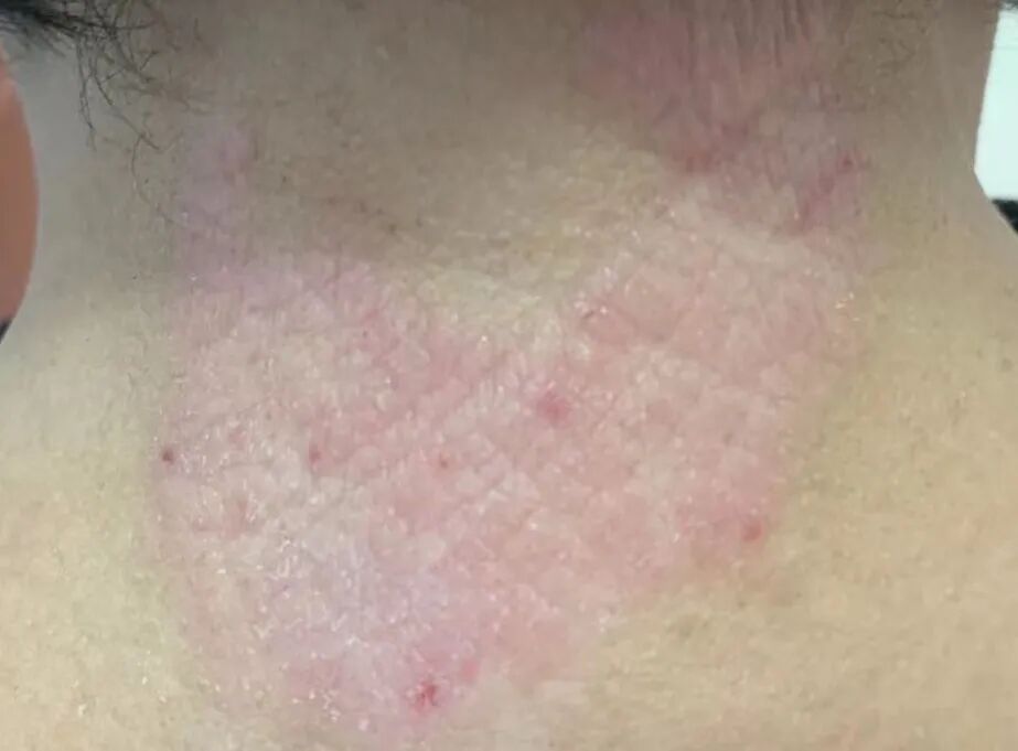 心情不好，皮肤发痒、变厚，像砂纸一样，当心这种皮肤病！