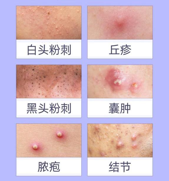 治宜清上畅下，凉血散结！从中医的角度详细讲解“成人青春痘”的